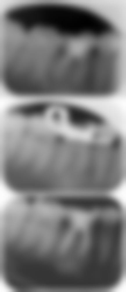 根尖周炎导致牙槽骨增生的症状