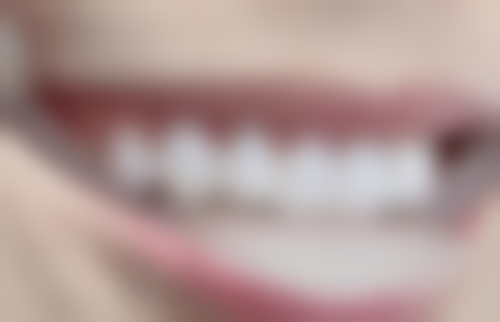 术后炎症对根管治疗后咬合不痛时间的影响大吗？