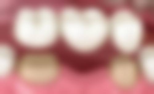 湘潭七颗牙口腔真实实例:见证神奇的口腔蜕变