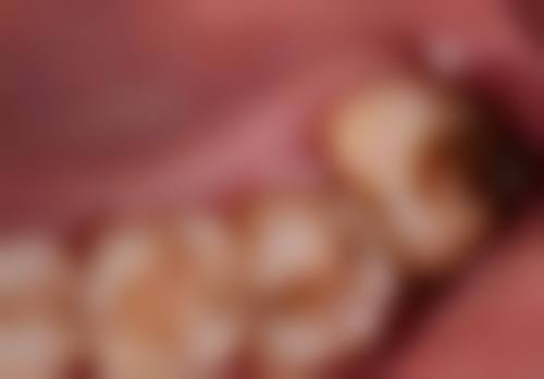 根管治疗什么时候补牙？了解这3个关键时间点，让你的牙齿修复效果提升80%，告别牙痛困扰！ 