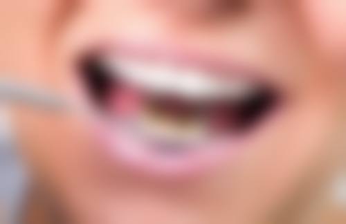 根管治疗后补牙的至佳时间如何确定？