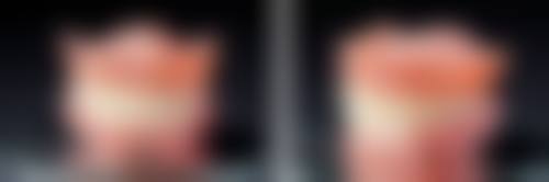 拔牙后口含冰块有哪些注意事项？