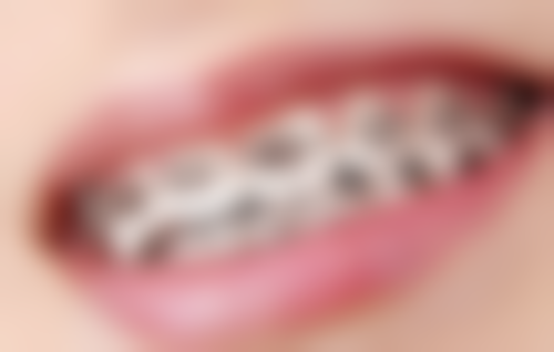 儿童地包天可以矫正吗？揭秘3种有效矫正方法，把握黄金矫正期让孩子笑容更自信！ 