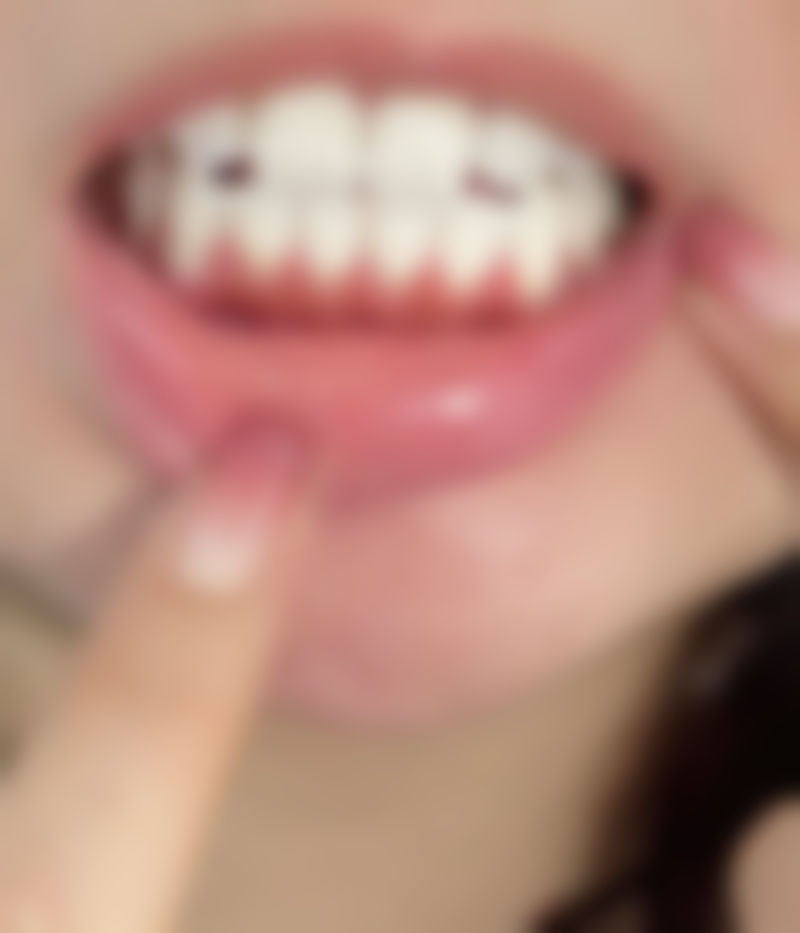 牙齿根管治疗术后牙齿还痛吗?揭秘术后疼痛真相，掌握这3大缓解方法，让你轻松告别牙痛困扰！ 