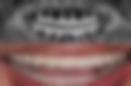 小诊所根管治疗的风险有哪些？