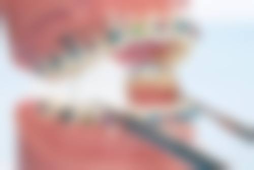 有牙结石洗牙时要注意什么?