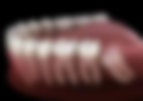 38岁做牙齿矫正选择传统托槽矫治器怎么样?