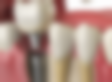 辽宁曙光整形外科医院做全瓷牙还是烤瓷牙哪个更适合我？