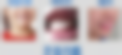 如何让根管治疗的牙齿使用年限更长久?