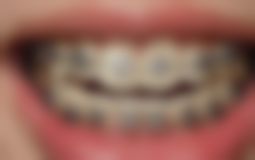 辽宁曙光整形外科医院矫正1岁地包天靠谱吗