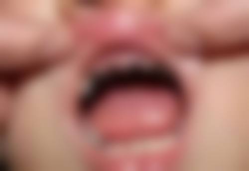 补牙戴套的成效怎么样?