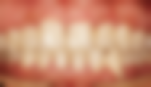 全瓷和烤瓷牙冠在武科 大附属紫荆医院修复成效怎么样