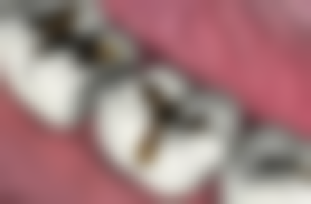 艾迪升整形外科的全瓷和烤瓷牙冠修复技术如何