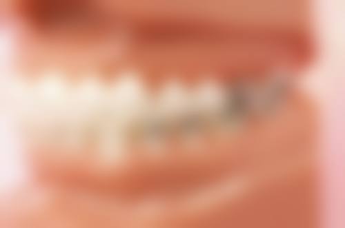 自己用树脂补牙后要注意什么？