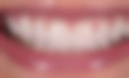 选择不同医院安装全瓷牙后适应时长对生活影响大吗?