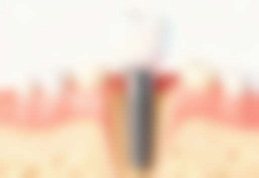 洗牙后严格遵守两小时吃东西规则值不值？