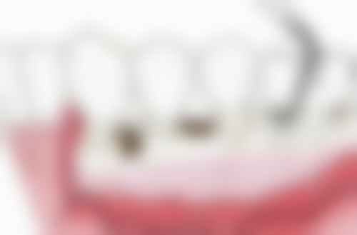 全口种植牙在北京画美医疗美容靠谱吗？