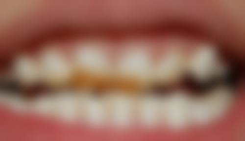 补牙后一阵一阵的疼痛选长沙利尔口腔门诊部值不值？