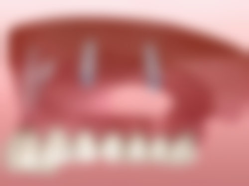 拔牙后一个半月在北京圣嘉新医疗美容医院种牙怎么样