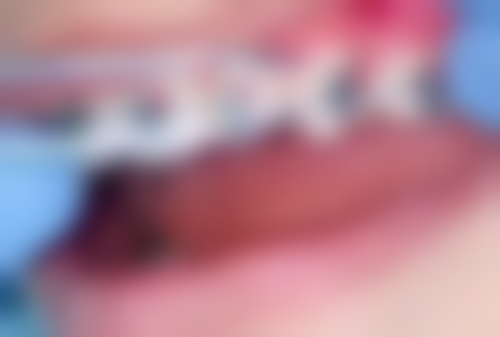 补牙前洗牙和不洗牙的区别大吗