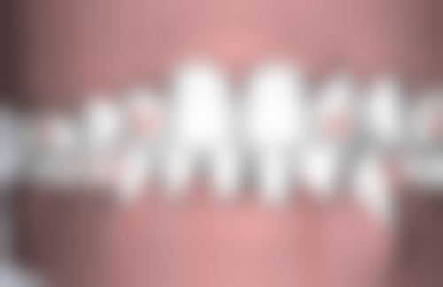 烤瓷牙松动是什么感觉？牙齿敏感、咀嚼无力、轻微疼痛，这些症状你中招了吗？ 