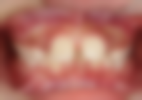 根管治疗按根管根数算费用适合所有患者吗