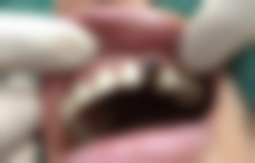 运城嘉悦周颖口腔瑞士 ITI 种植的技术优势