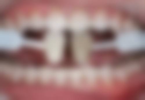 补牙前后能吃东西吗？补牙前正常饮食，补牙后2小时内禁食，24小时后可吃软食，了解这些很重要！ 