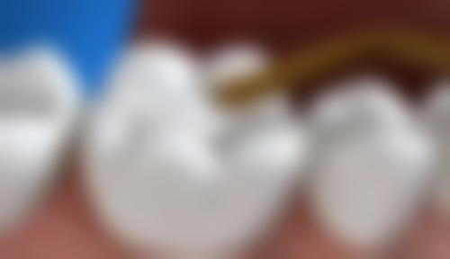 陕西商洛牙管家口腔真实实例:见证神奇变化