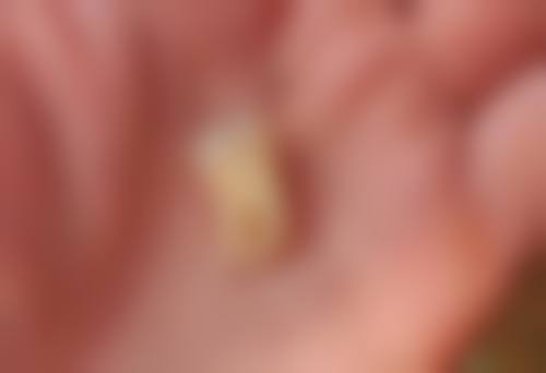 全口allon4种植25000元适合吗