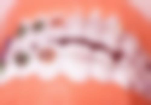 洗牙用多长时间一次？专业牙医建议：健康人群半年到一年洗一次，牙周病患者每三个月洗一次！ 