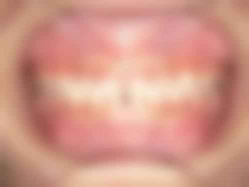 天津瑞鑫口腔真实实例:见证奇迹的时刻