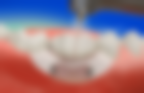 河南南阳方城万超口腔诊所陈旭医生做牙齿正畸值不值