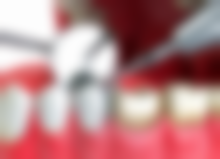 门牙根管治疗后如何选择合适的牙冠