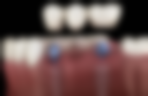 安徽亳州小天使口腔（光明店）真实实例