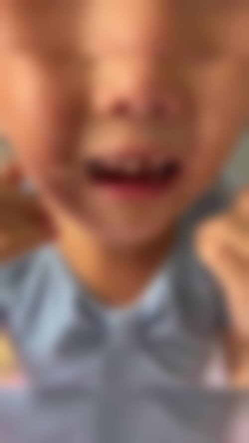 西安中诺口腔【智齿拔除】上颌正位智齿 | 成人拔智齿+拍片不含麻，仅需380元起，精准操作创伤小恢复快 