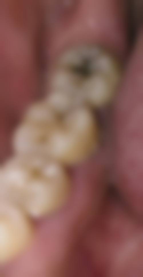 西安中诺口腔根管治疗（前磨牙、成人含补牙 + 拍片）的成功实例