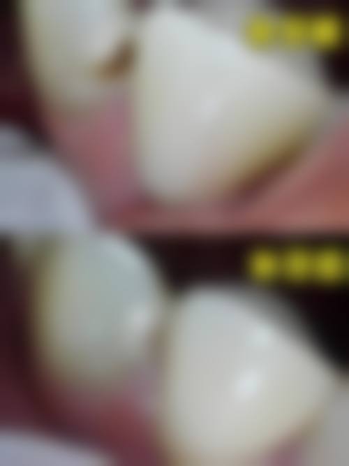 西安中诺口腔根管治疗（前磨牙、成人含补牙+拍片），精准治疗，高效恢复，380元起！ 