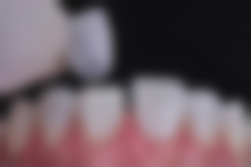 全口拔牙影响面部外形值不值