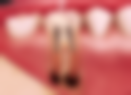 韩系种植牙品牌性价比高是真的吗？