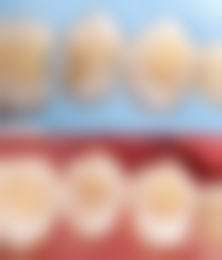 深度龋齿需要做根管治疗吗