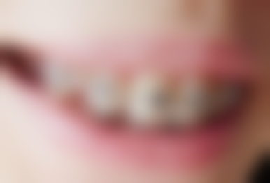 儿童洗牙适合所有孩子吗