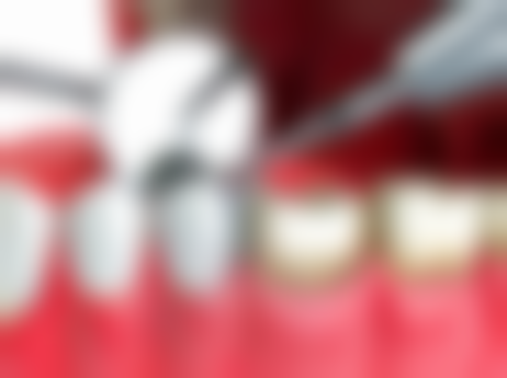 如何判断洗牙后牙龈出血是否正常