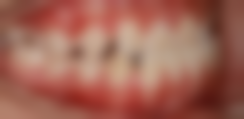 全瓷牙德国威兰德能改善变色牙问题吗