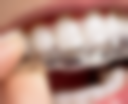 拔牙马上种植牙值不值