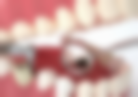 做的烤瓷牙有缝隙能自己修复吗?