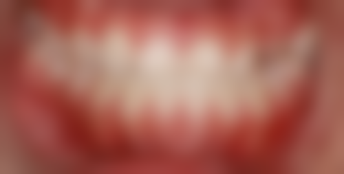 补牙后控制饮食温度靠谱吗？