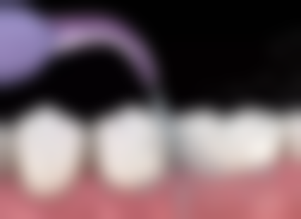 20岁种植牙齿值不值