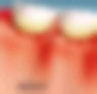 拔牙智齿流血不止会感染吗