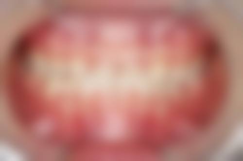 齐河文霞口腔诊所真实实例：见证神奇的口腔蜕变